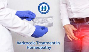 Homeopathy treatment for varicocele